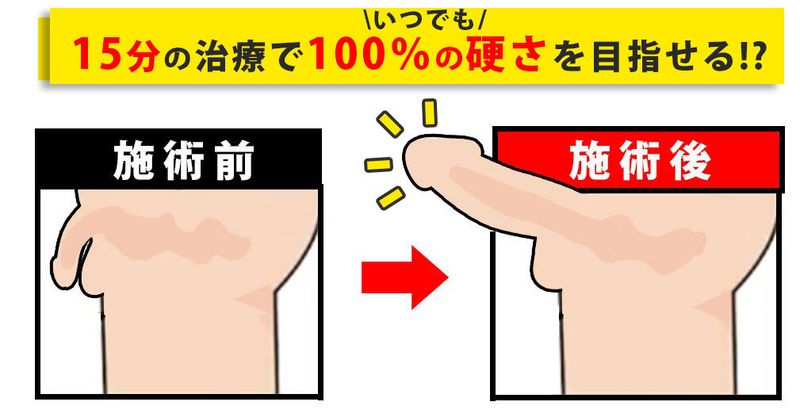 15分の治療で100%の硬さを目指せる!?
